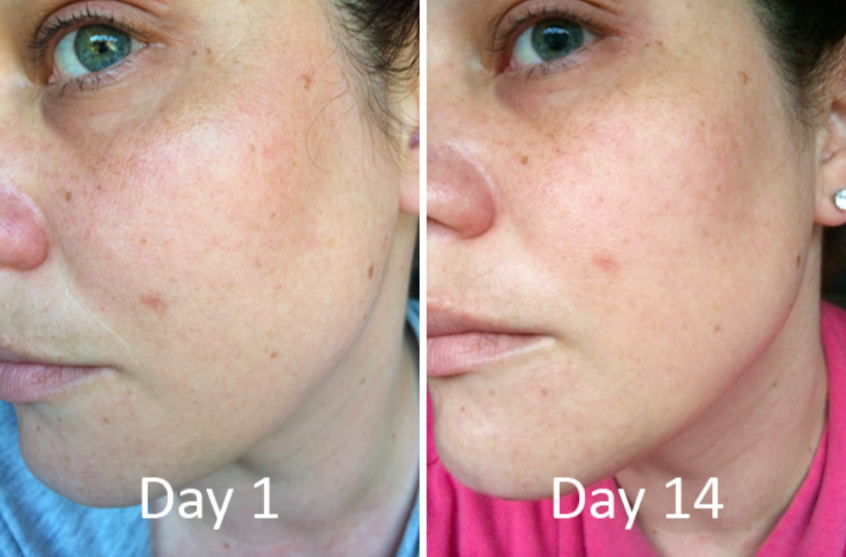 Lactic Acid Peel vs. Glycolic Acid Peel - Refresh Skin Therapy