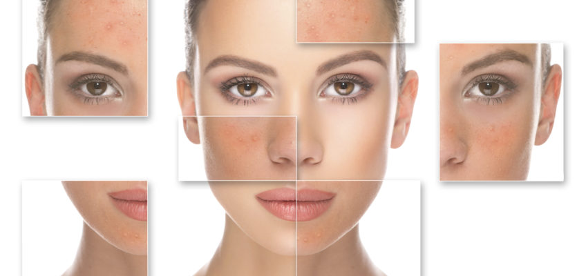 lactic acid peel works on acne and wrinkles
