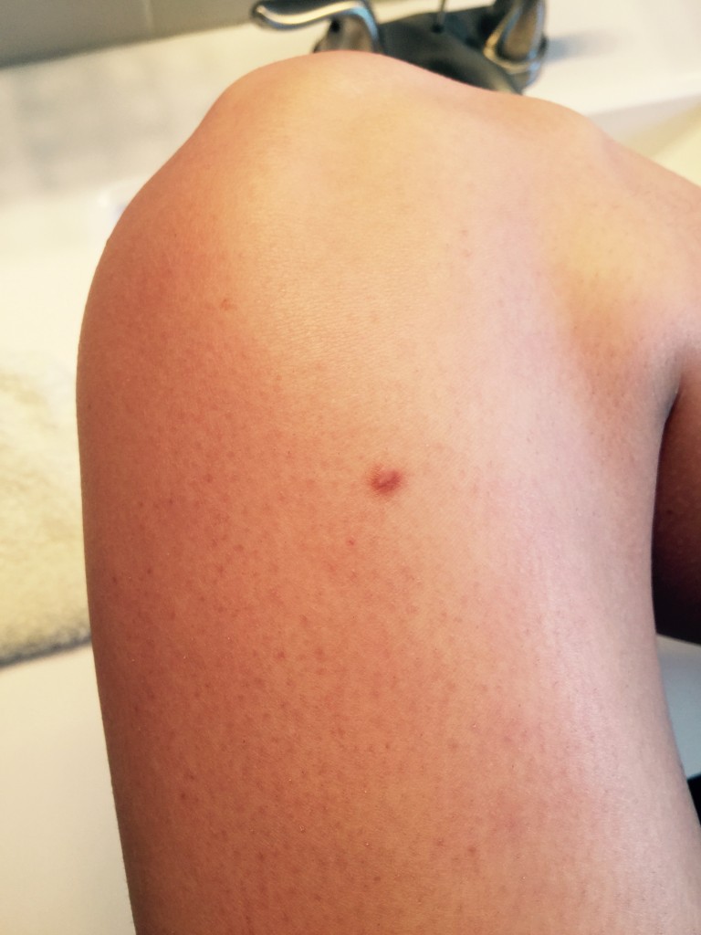 Scar Fade Challenge Refresh Skin Therapy